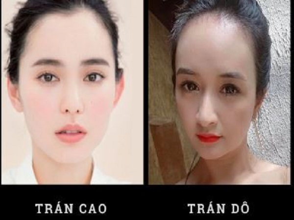 Phân biệt trán dô và trán cao