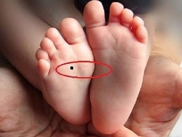 Tướng mụn ruồi bàn chân tốt hay xấu