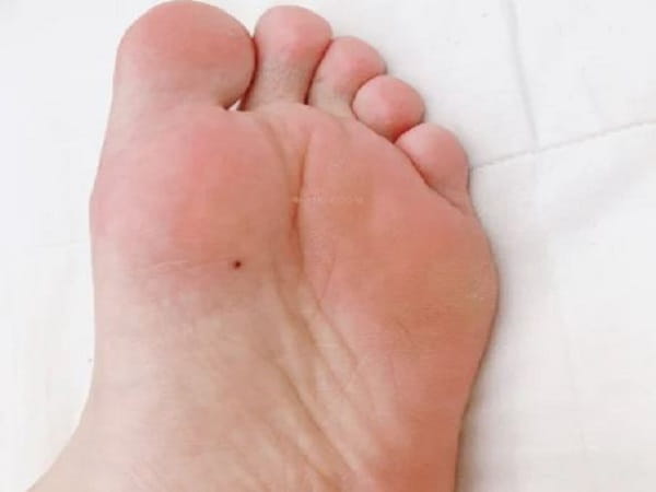Luận nốt ruồi ở lòng bàn chân trái