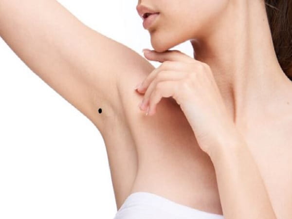 Mụn ruồi ở nách tốt hay xấu – nên xóa hay giữ lại?
