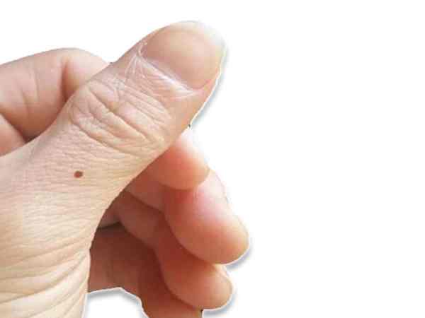  Nốt ruồi ngón tay cái bên phải nam giới