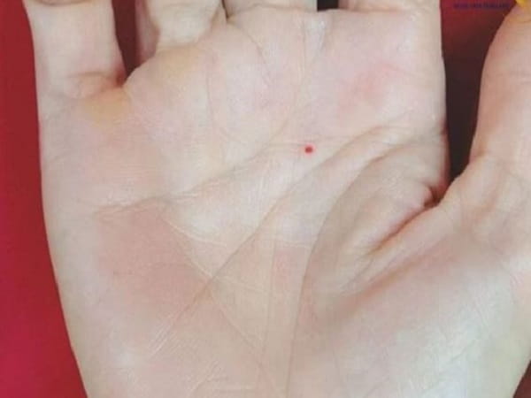 Nốt ruồi trong lòng bàn tay trái ở nam