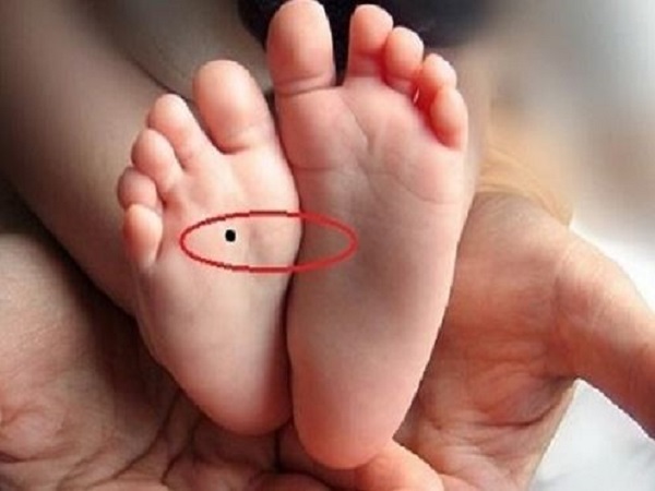 Nốt ruồi ở lòng bàn chân phải nữ