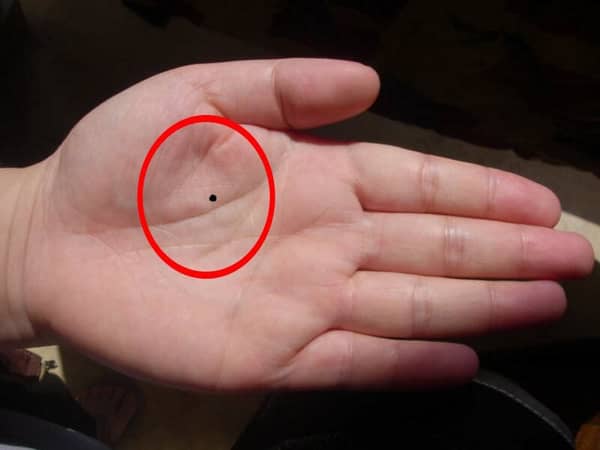 Có nên xóa nốt ruồi lòng bàn tay phải không?
